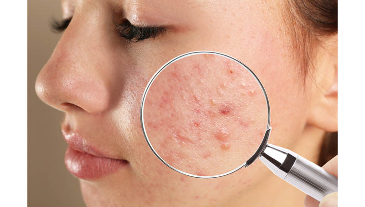 শীতে ব্রণের সমস্যায় নাজেহাল! জেনে নিন বিশেষজ্ঞের মত